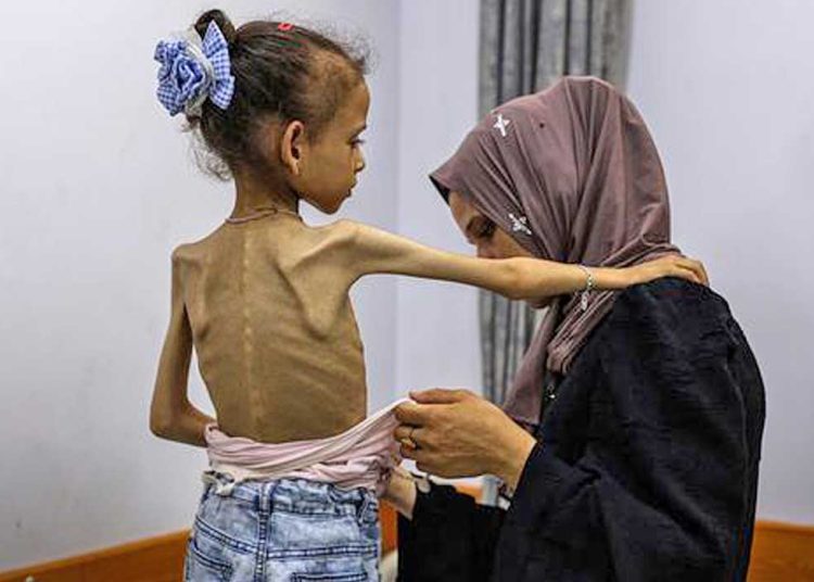 SEORANG gadis menderita malnutrisi parah di Gaza. Tim bantuan telah berulang kali meminta Israel untuk mengizinkan lebih banyak bantuan masuk ke Gaza guna mencegah bencana kemanusiaan yang sedang berlangsung. (foto fornews.co/who/pbb)